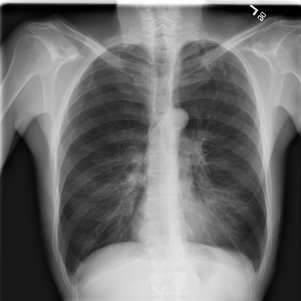 healthy lung xray