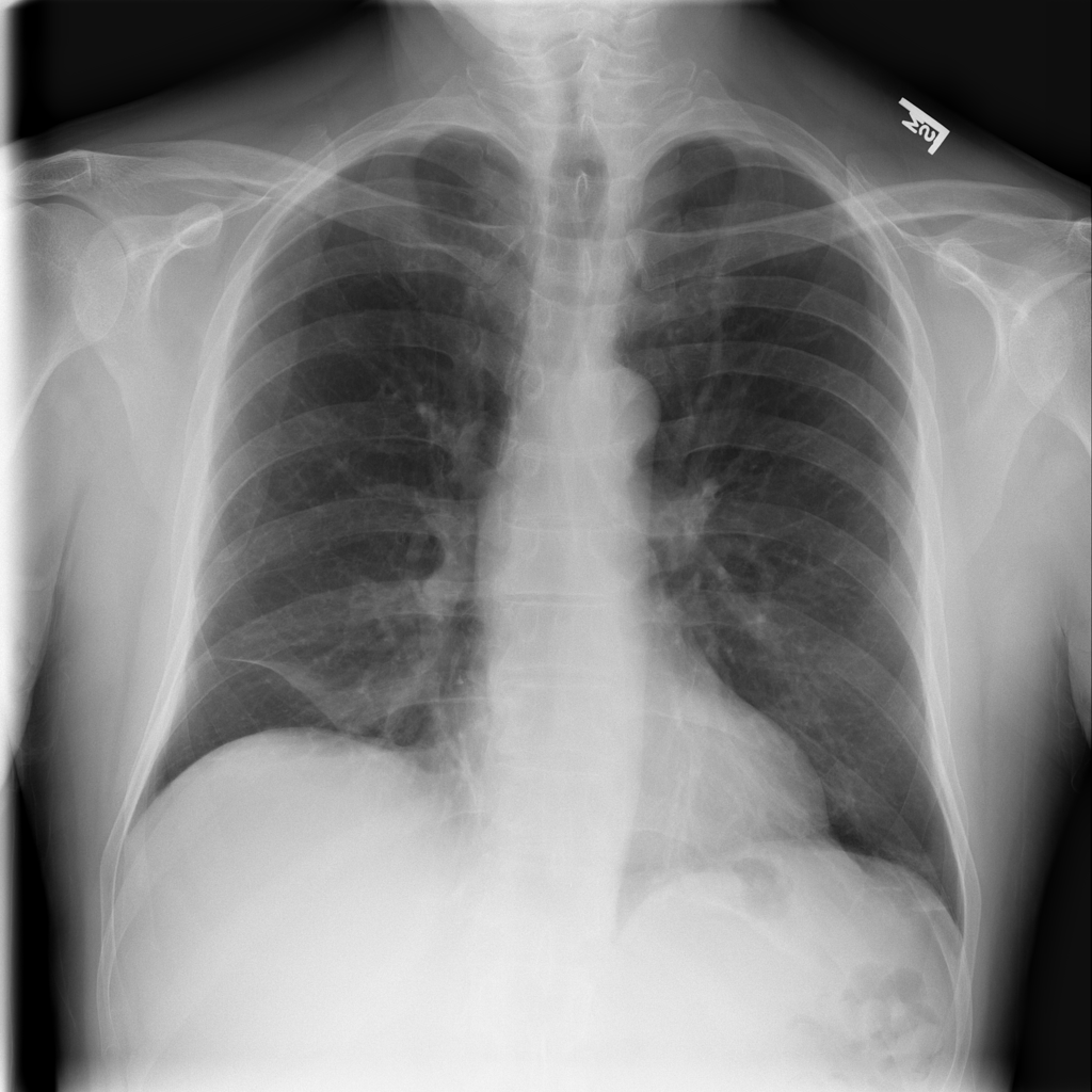 chest x ray pneumonia